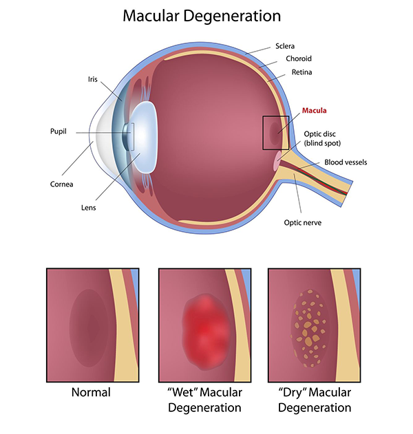 Monmouth County Age-Related Macular Degeneration